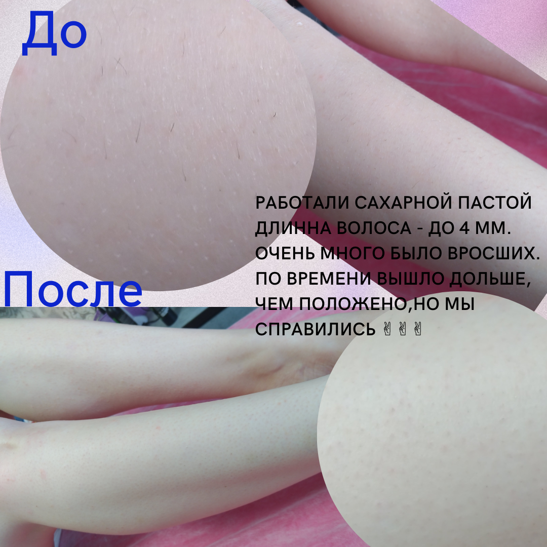 жидкое лезвие для пяток до и после, часть тела, после, смарт педикюр до и после, пятки до и после