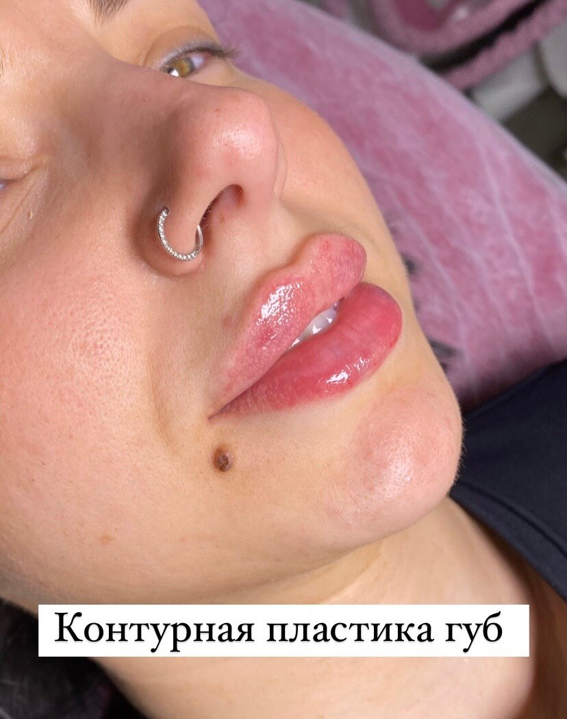 губы контурная пластика, пластика губ, филлеры для губ, губы ботокс, губы