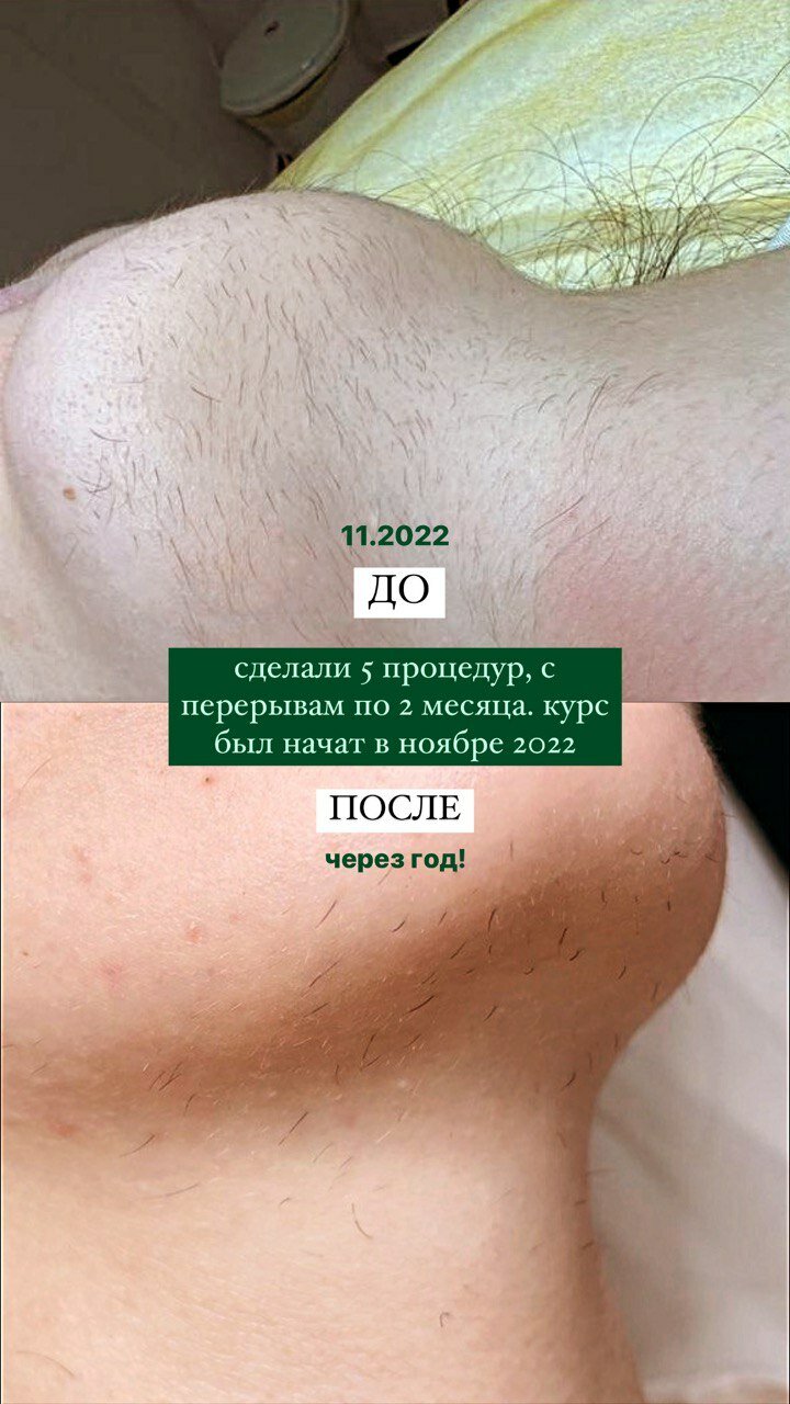 электроэпиляция после, после лазерной эпиляции, электроэпиляция, регулярная депиляция, электроэпиляция глубокого бикини