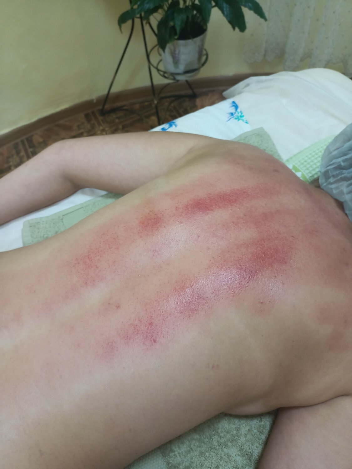 часть тела человека, гуаша, гуаша следы, гуа ша, гуаша петехии