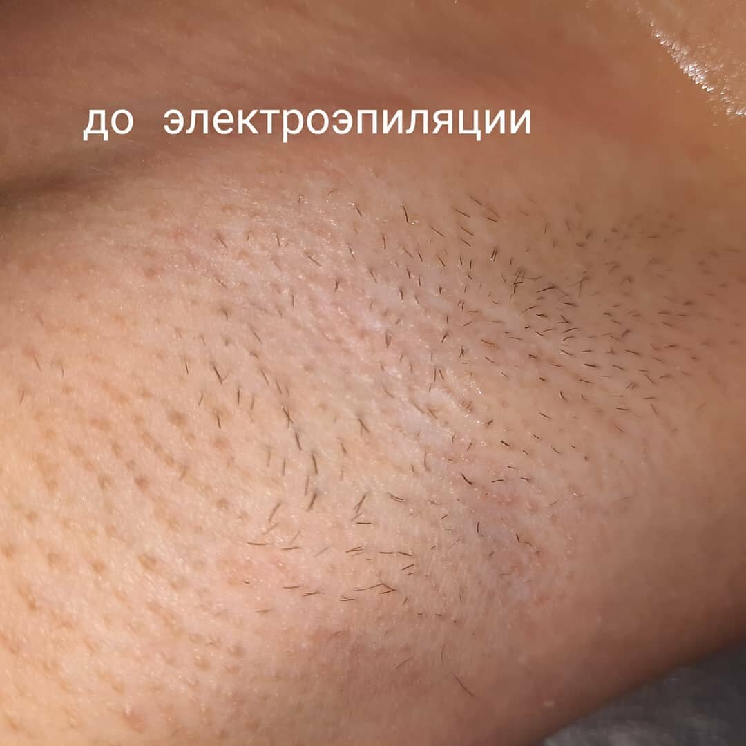 лазерная эпиляция, эпиляция, электроэпиляция, до и после лазерной эпиляции, депиляция