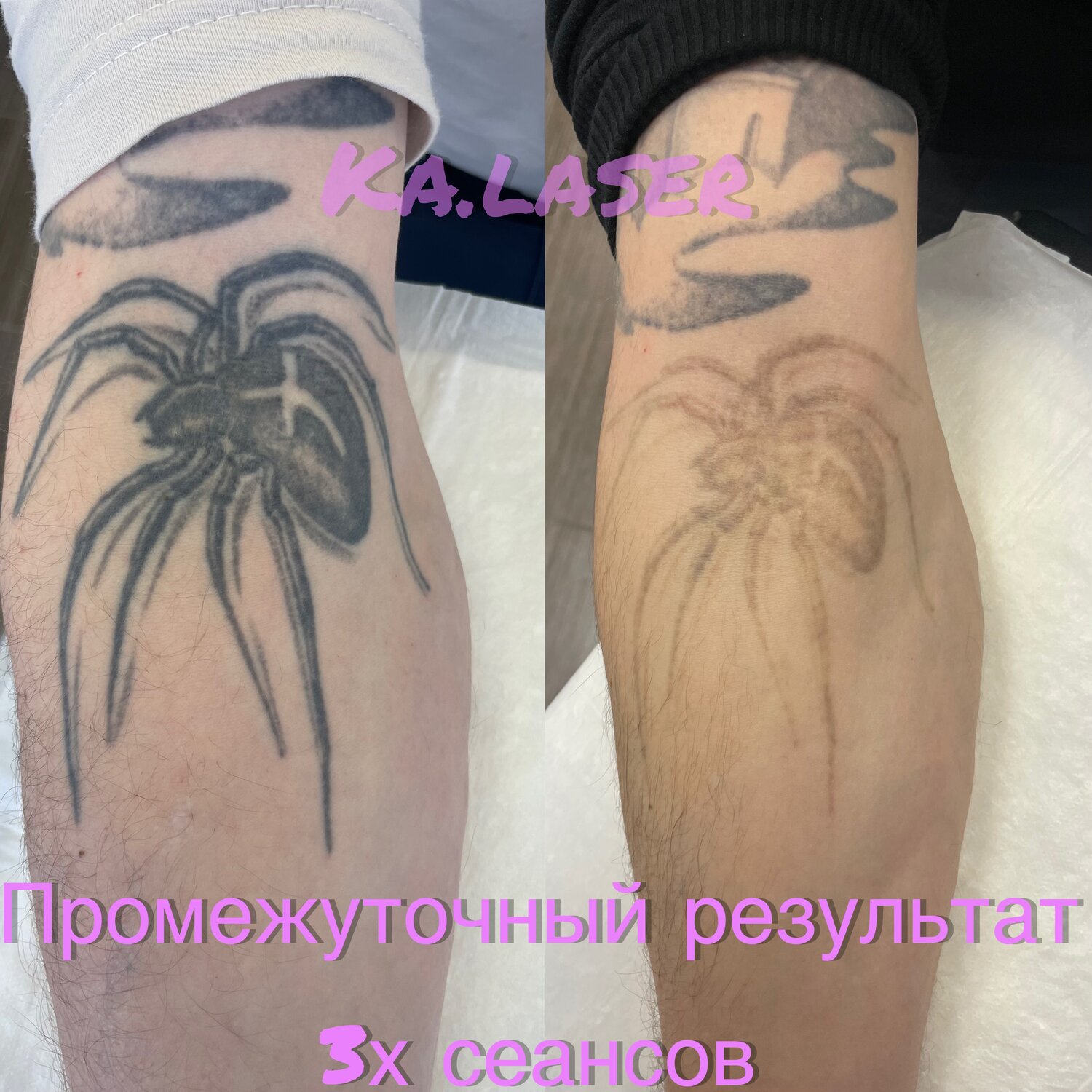 удаление татуировок лазером, выведение татуировок, тату, татуировки, удаление тату лазером