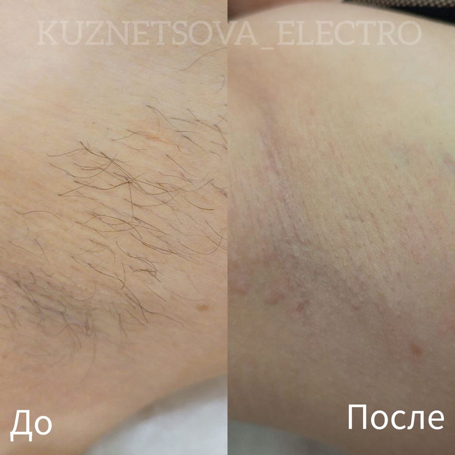 электроэпиляция, восковая депиляция, электроэпиляция результат , крупным кадром вытаскивает волос, электроэпиляция в москве, электроэпиляция зоны бикини