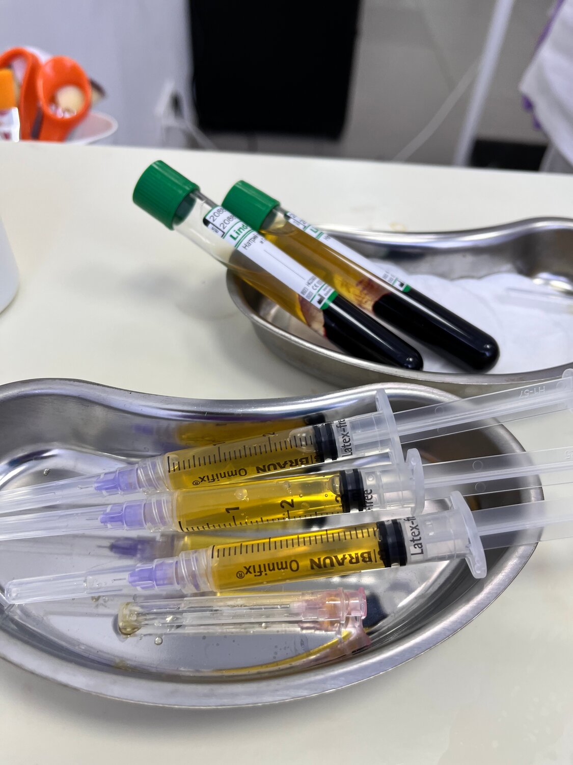 медицина, взятие биоматериала, плазмолифтинг акне, prp терапия regenlab, т-lab tube prp