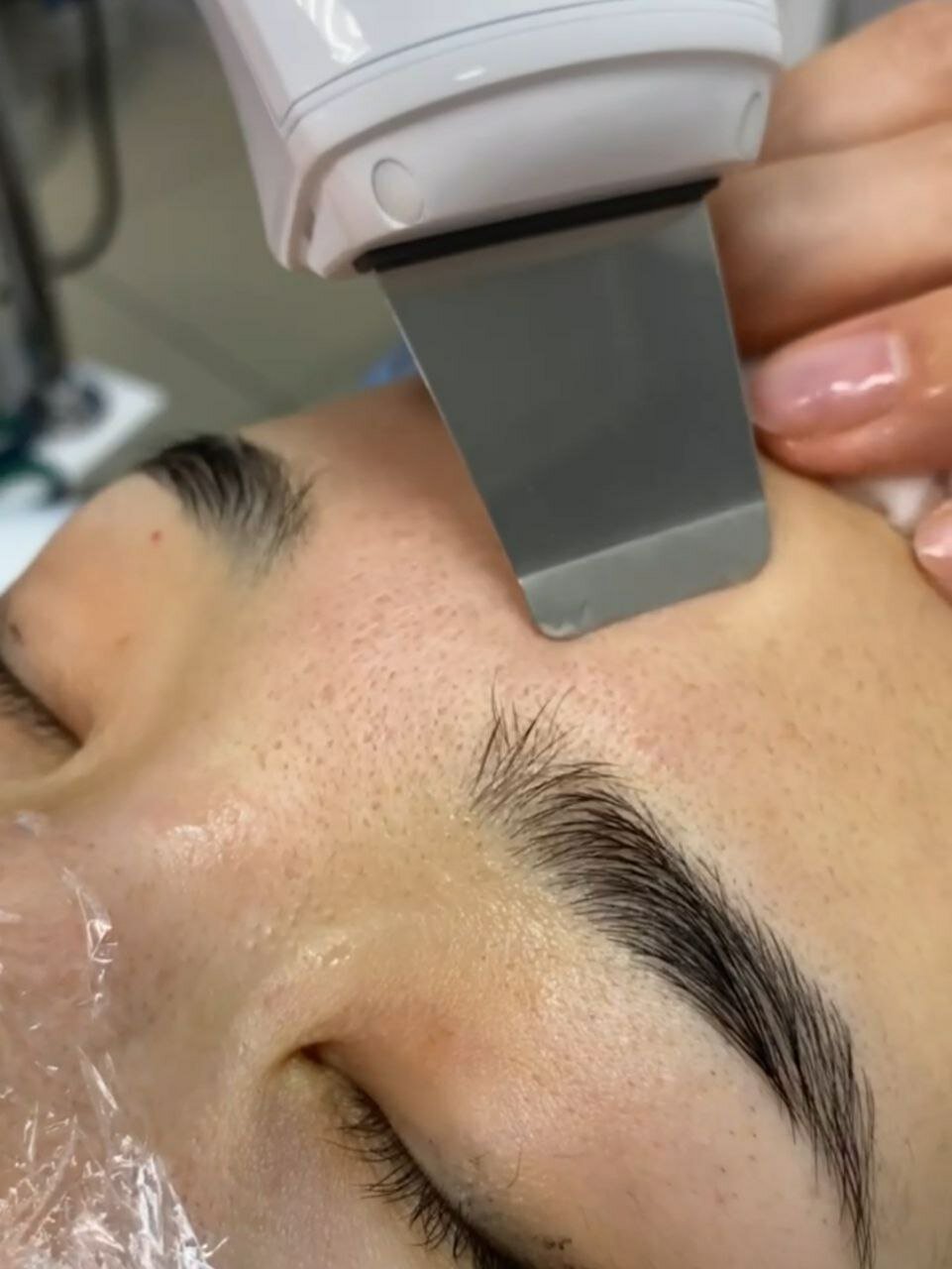 ультразвуковой пилинг, уз чистка лица, чистка лица, ультразвуковой пилинг лица, пилинг лица