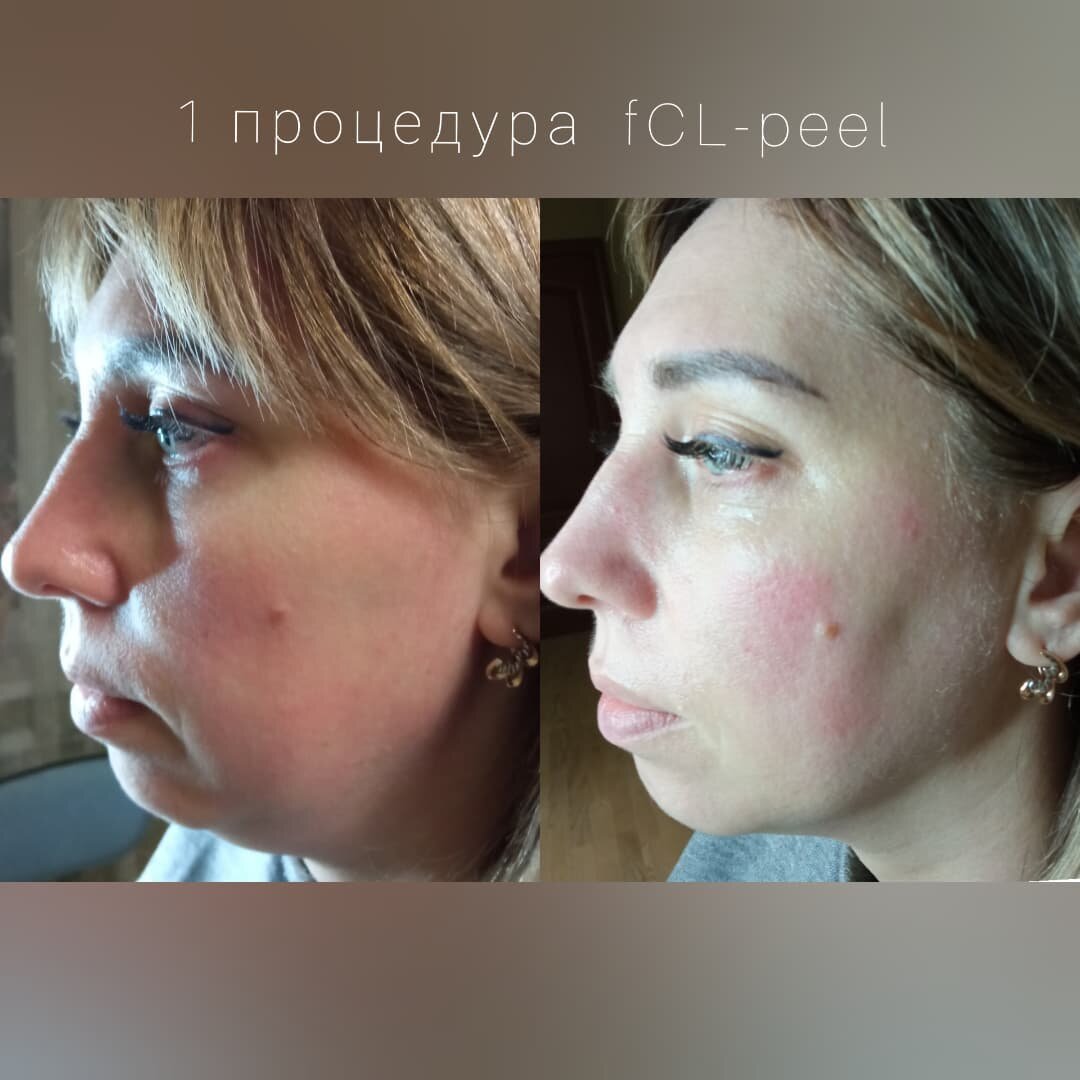 плазмолифтинг лица, дарсонваль для лица до и после, плазмолифтинг губ, плазмолифтинг, пластика лица