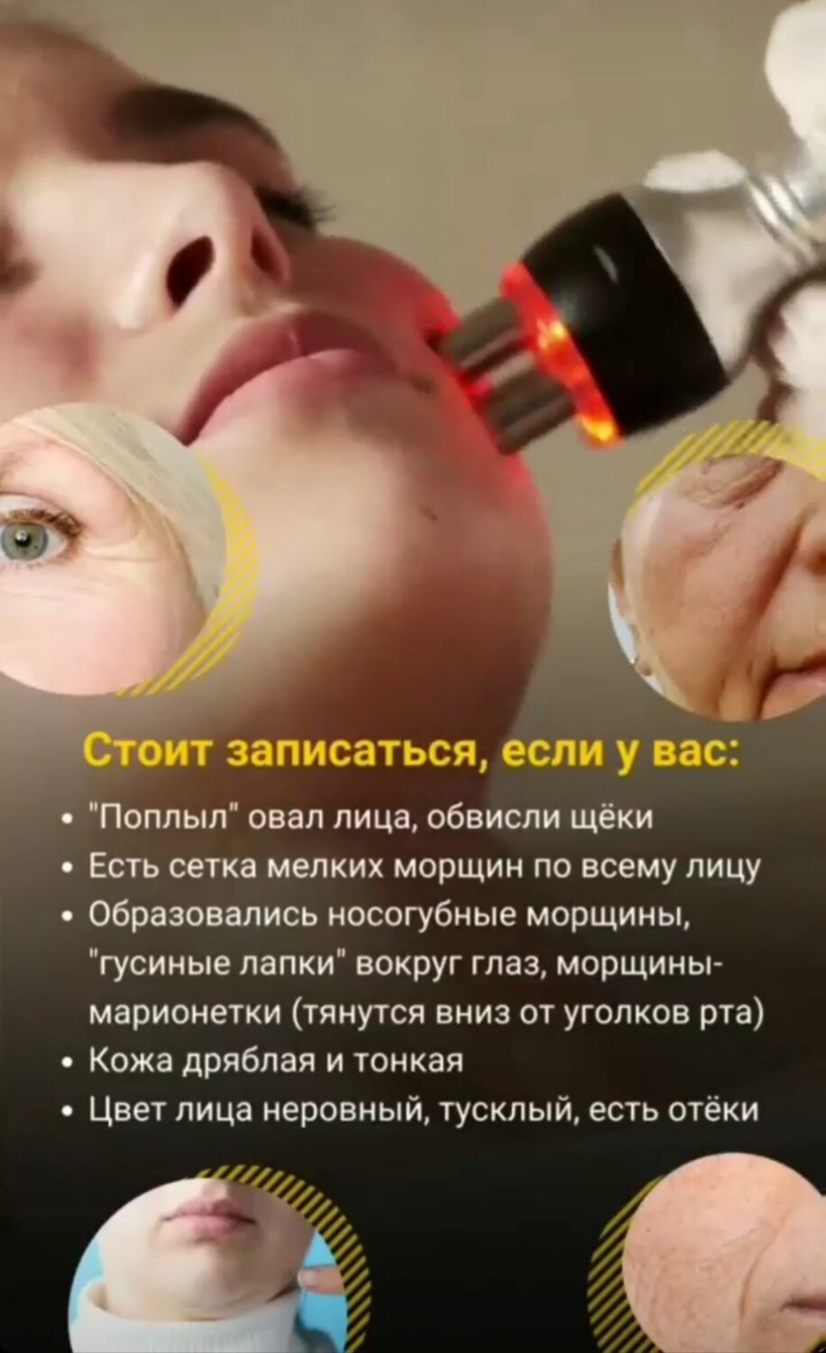 rf лифтинг лица, лифтинг лица, рф лифтинг, пилинг лица, процедуры для лица