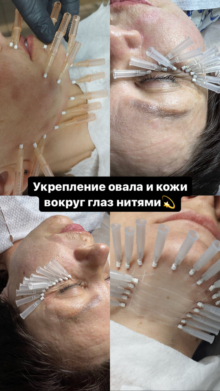 подтяжка лица мезонитями, мезонити, нити для лица, часть тела, нити