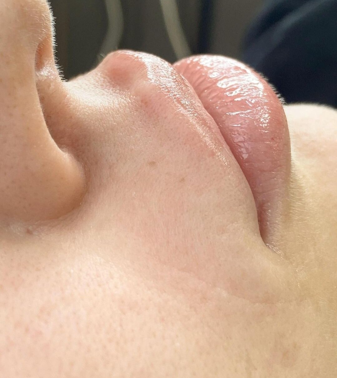 губы, увеличение губ, лазерная эпиляция лица для женщин, пластика губ, лазерная эпиляция лица
