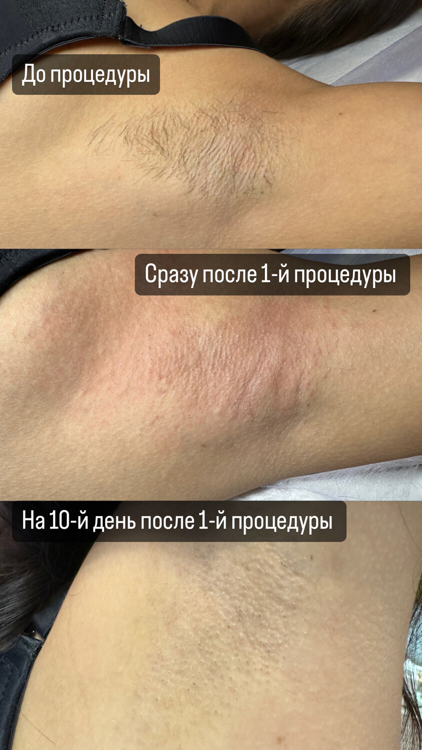 после лазерной эпиляции, электроэпиляция, до и после лазерной эпиляции, лазерная эпиляция голени до и после, результаты лазерной эпиляции