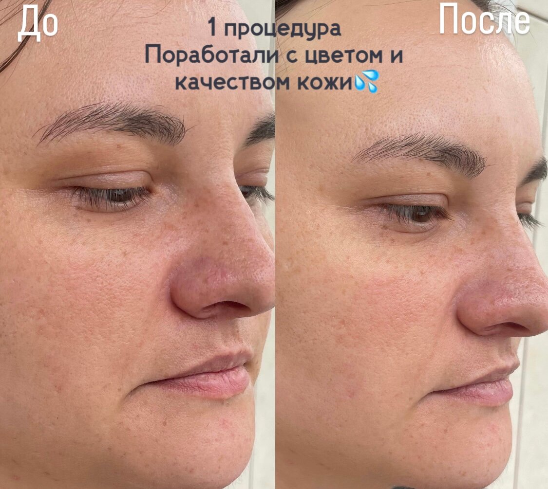 лазерный пилинг лица, пилинг лица лазером, процедуры для лица, лицо до и после косметолога, бб глоу процедура