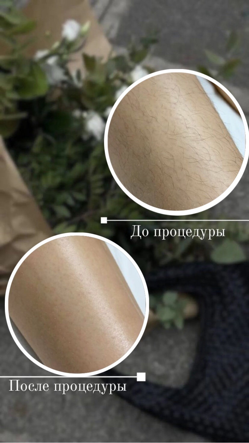 до и после лазерной эпиляции, после лазерной эпиляции, эпиляция до и после, лазерная эпиляция рук, восковая депиляция
