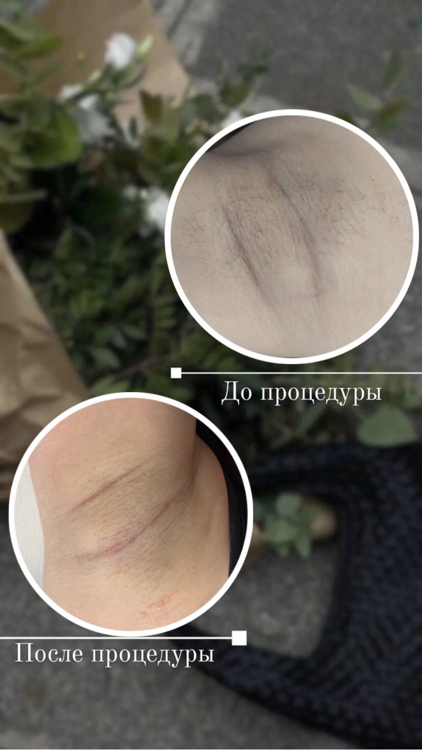 лазерная эпиляция, восковая депиляция, шугаринг депиляция, эпиляции, мастер лазерной эпиляции