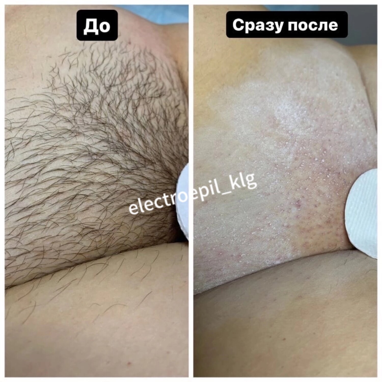 электроэпиляция глубокого бикини, восковая эпиляция глубокое бикини, шугаринг бикини глубокое, зона бикини эпиляция классическое, электроэпиляция