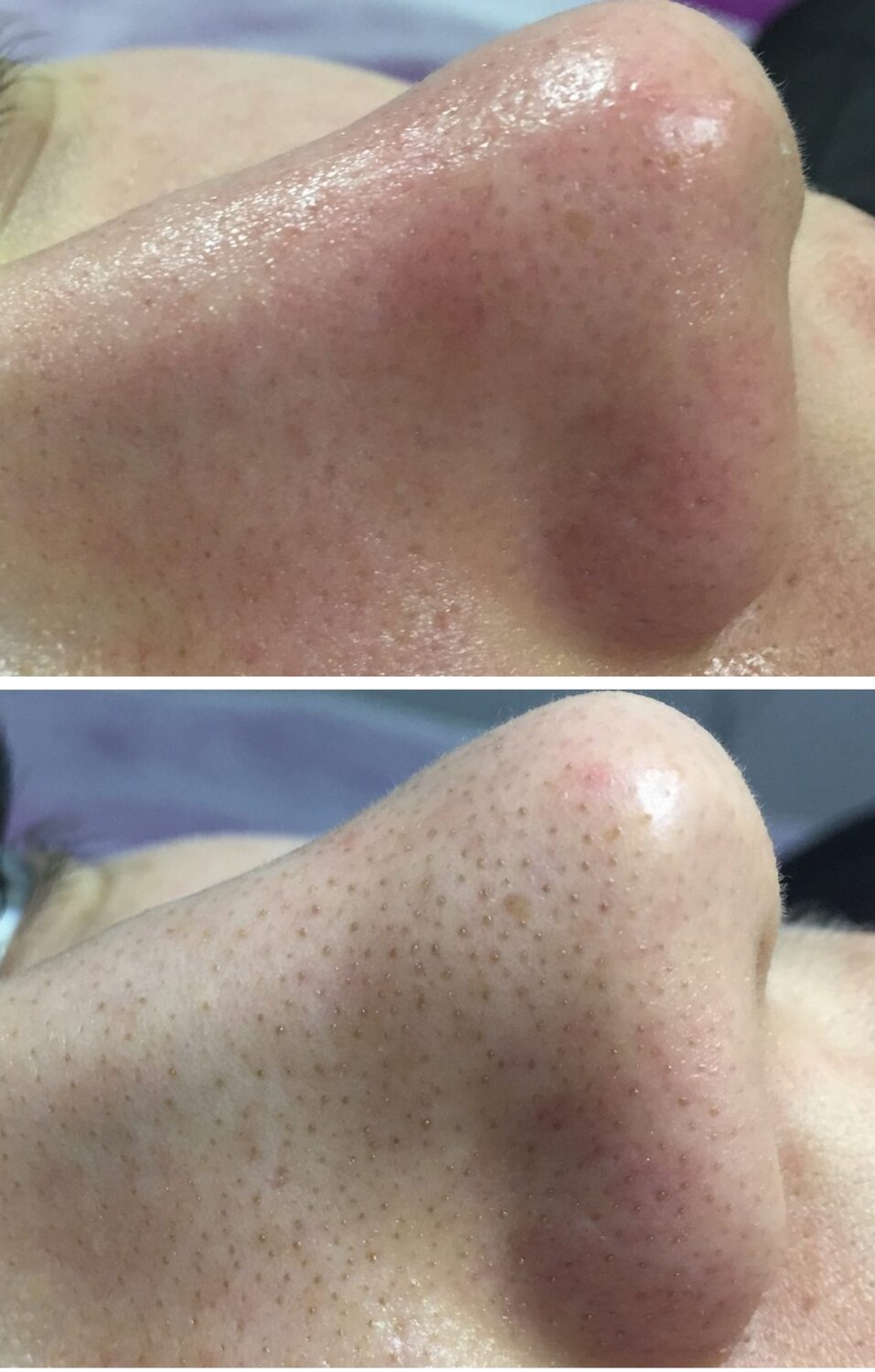 после чистки лица, чистка лица, уз чистка лица, черные точки, очищение кожи лица