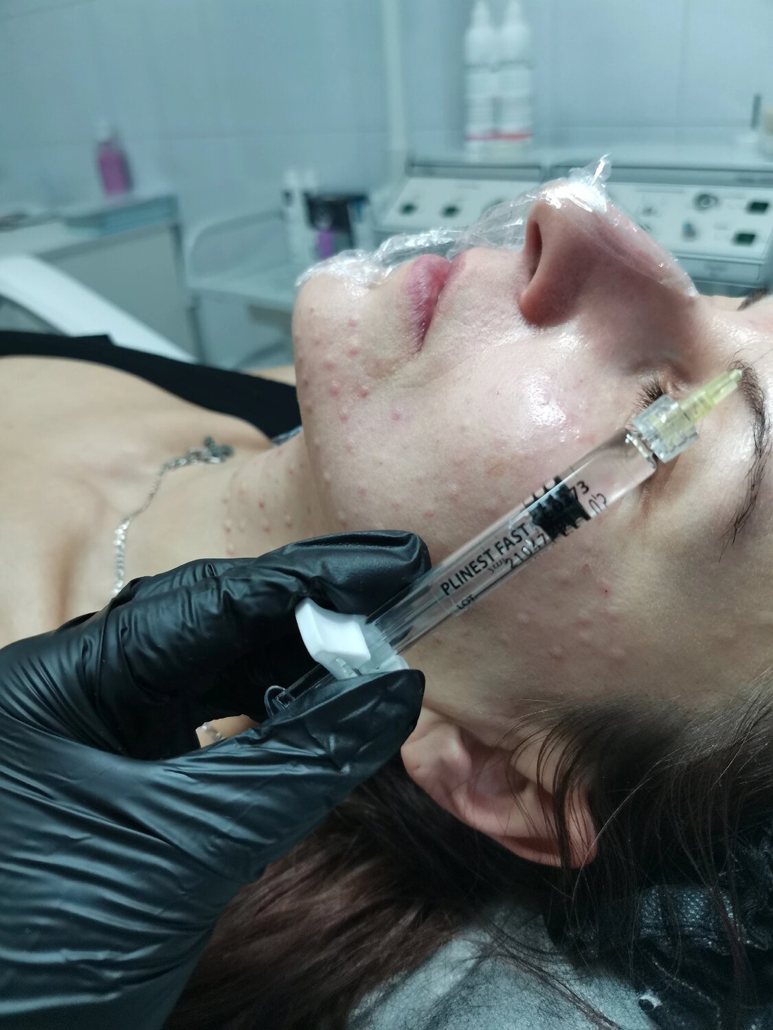 мезотерапия лица, биоревитализация лица, биоревитализация хуарон, биоревитализант, мезотерапия