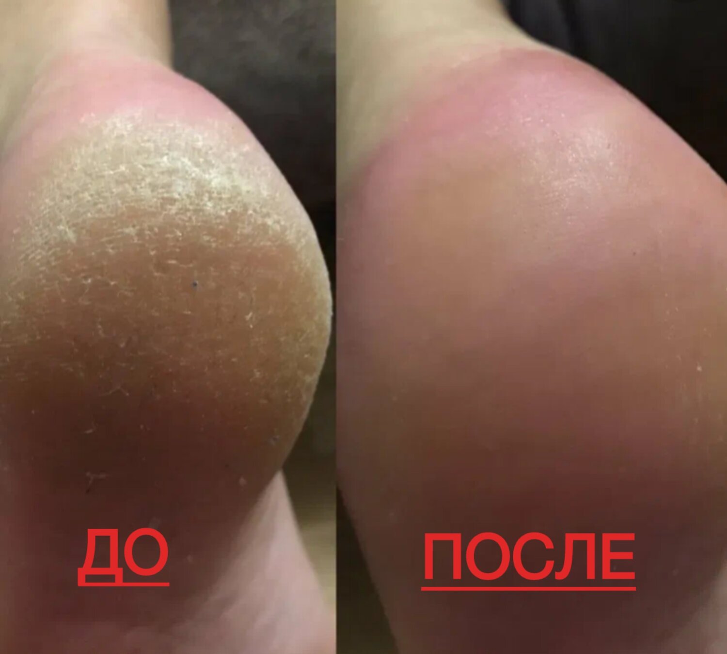 смарт педикюр до и после, аппаратный педикюр до и после, педикюр классический, педикюр, пилинг для ног