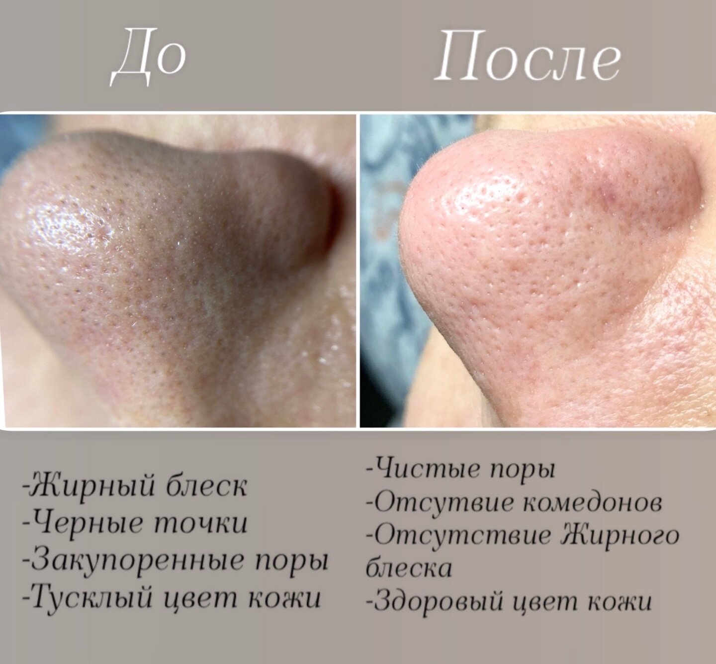 после чистки лица, кожа после чистки лица, черные точки, чистка лица, комбинированная чистка лица