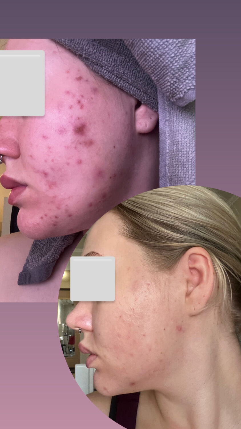 акне, лечение акне, фотолечение акне, acne treatment, анти акне