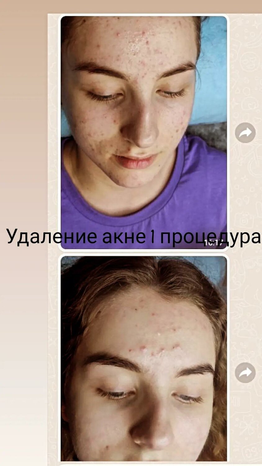 акне, угри акне, лечение акне, прыщи акне, акне и постакне