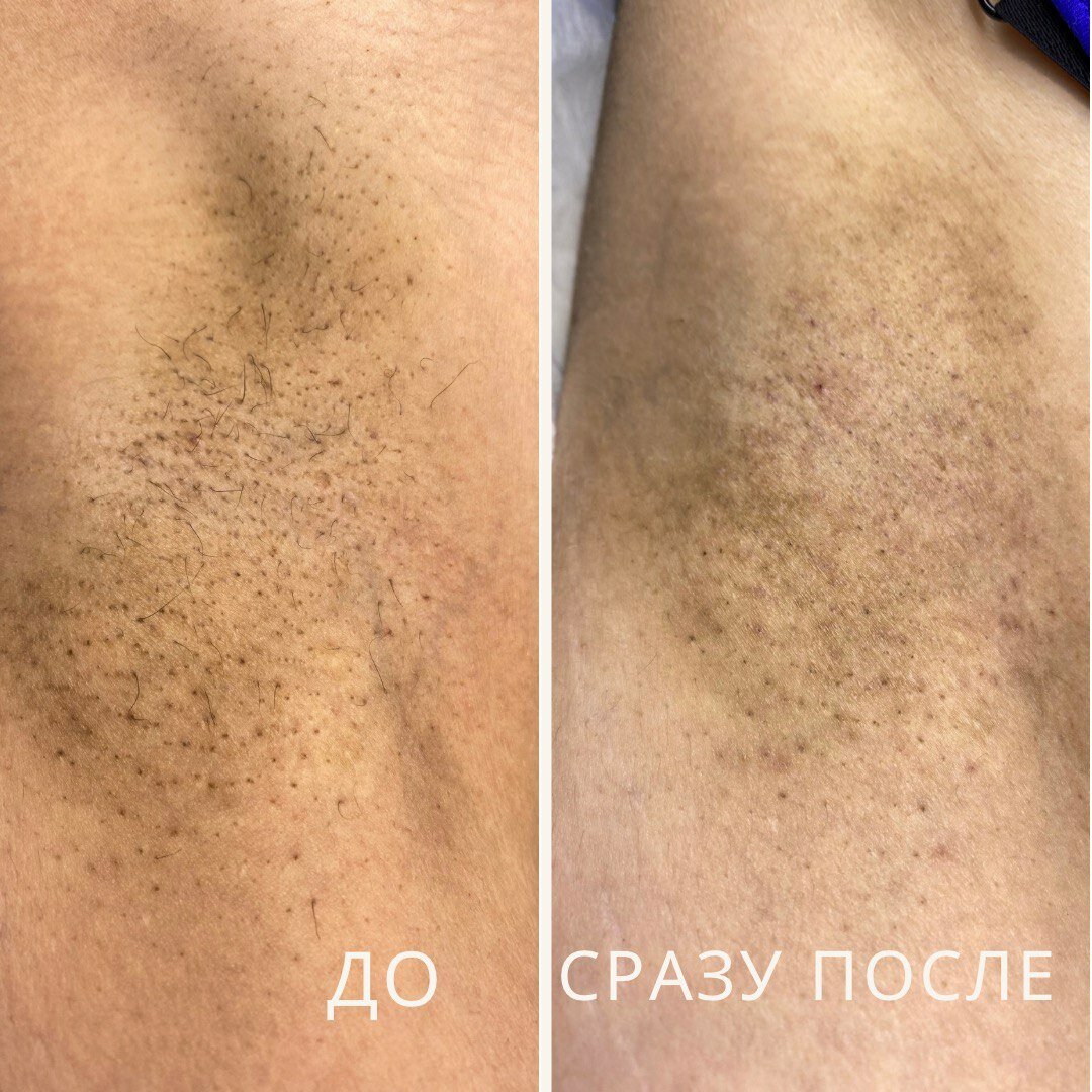 после лазерной эпиляции, эпиляция, лазерная эпиляция, лазерная эпиляция комплекс, восковая депиляция