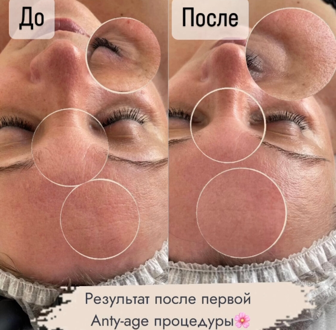 чистка лица, комбинированная чистка лица, уз чистка лица, процедуры для лица, пилинг