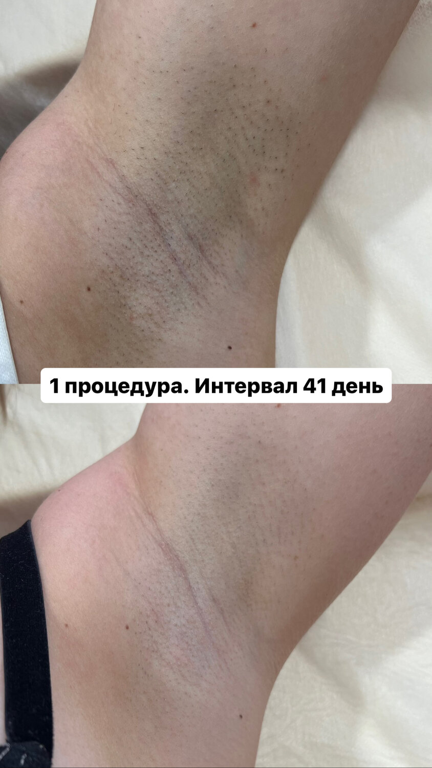 лазерная эпиляция, результат лазерной эпиляции, после лазерной эпиляции, элос эпиляция, результат после лазерной эпиляции