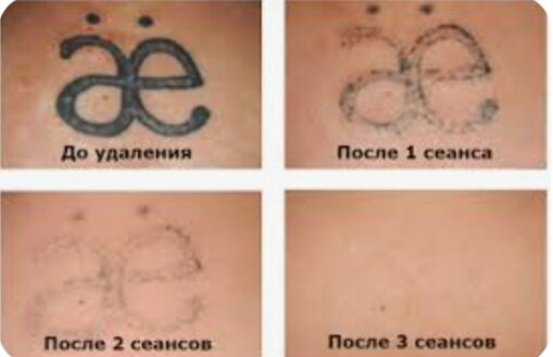 выведение тату лазером, после удаления тату лазером, удаление татуировок лазером, удаление тату лазером, после удаления тату
