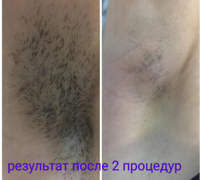 электроэпиляция, депиляция лазером, депиляция глубокого бикини, шугаринг глубокого бикини, лазерная депиляция