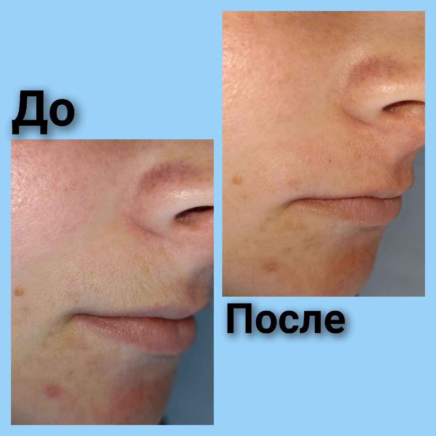 до и после аппаратом для ультразвуковой чистки, liftera до и после, после, лазерная эпиляция подбородка после 1 процедуры, электропорация до и после
