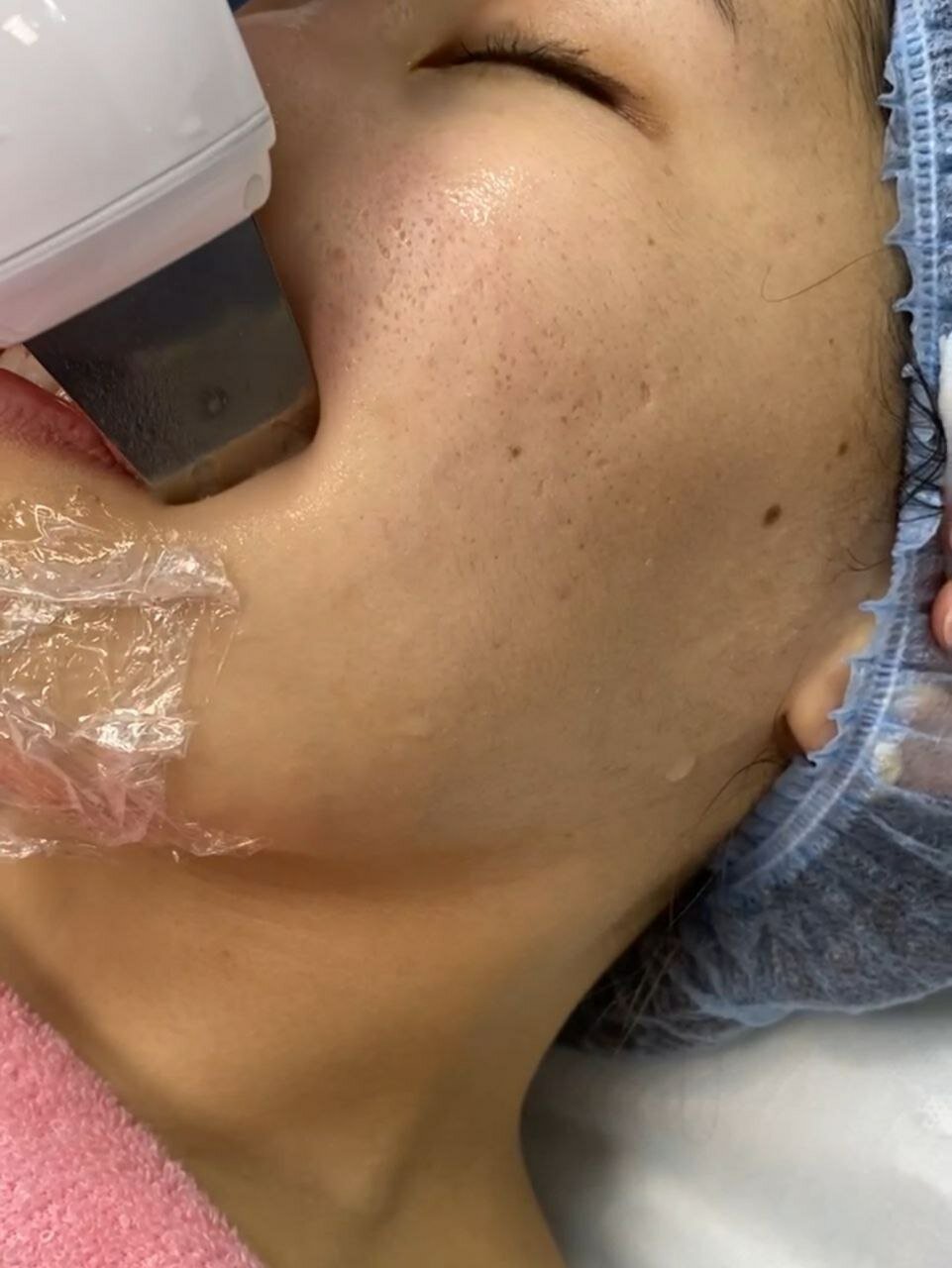 ультразвуковой скрабер для чистки лица, ультразвуковой пилинг, ультразвуковой пилинг лица, уз чистка лица, чистка лица