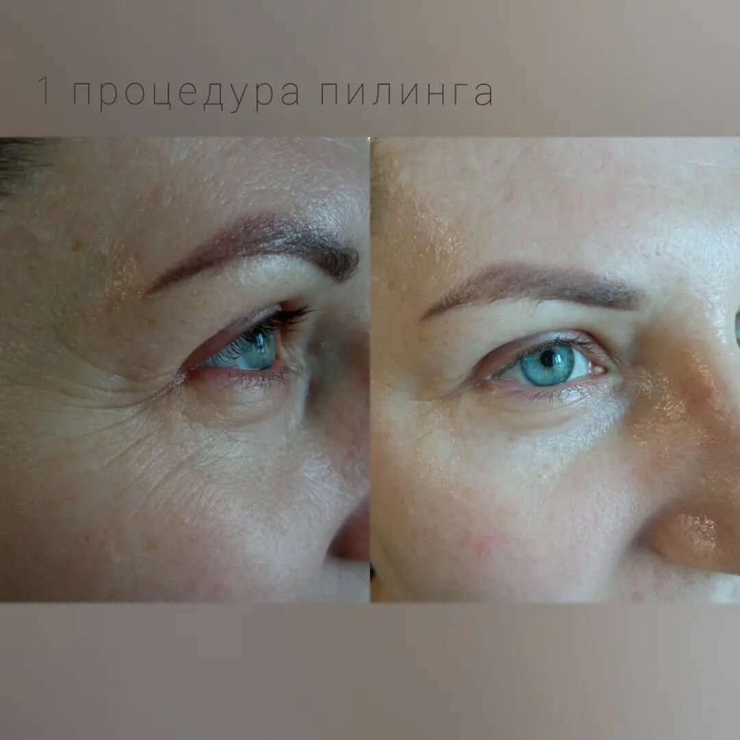 блефаропластика гварамия, блефаропластика, плазма лифт, есо2 лазерный пилинг, блефаропластика верхних