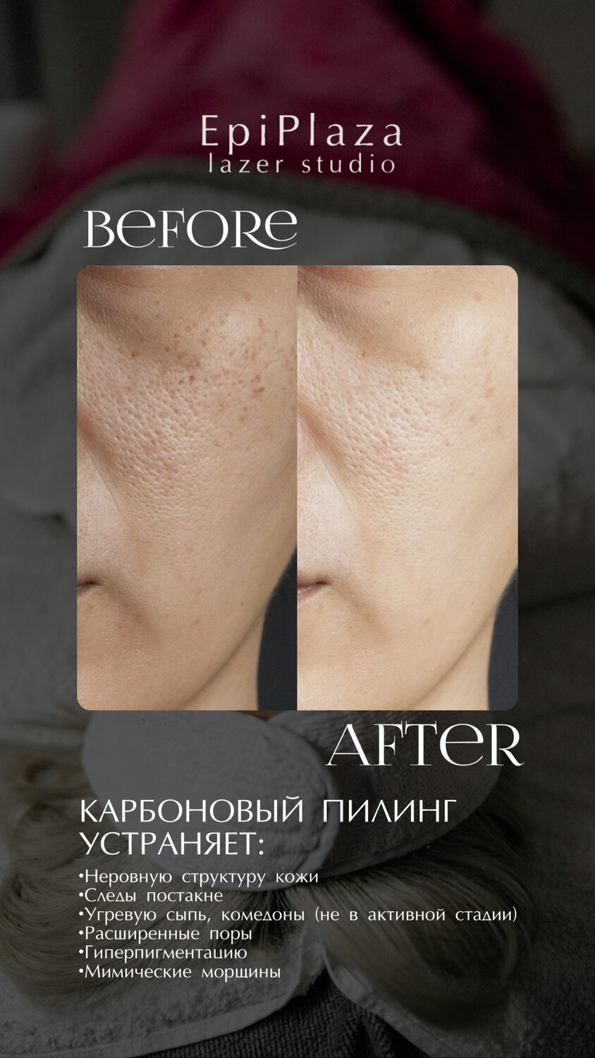 кожа лица, глубокий пилинг, пилинг, гладкая кожа лица, тусклая кожа лица