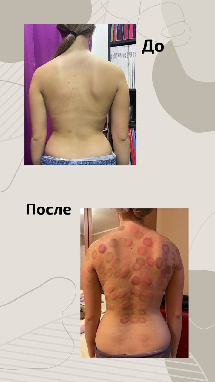 сколиоз после массажа, после, лечебный массаж, cupping therapy, спина