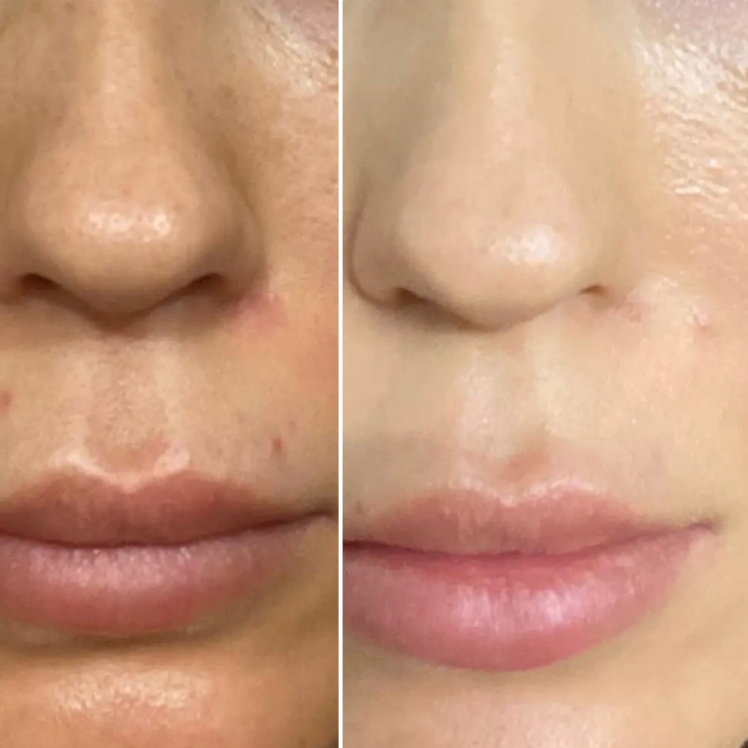 увеличение губ, увлажнение губ, гиалуроновая кислота, дермапен для губ, губы ботокс