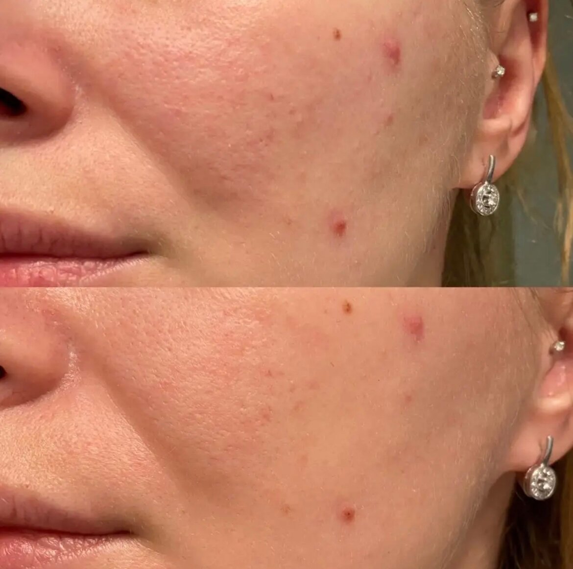 акне до после, постакне, лицо после чистки, акне постакне, лечение акне