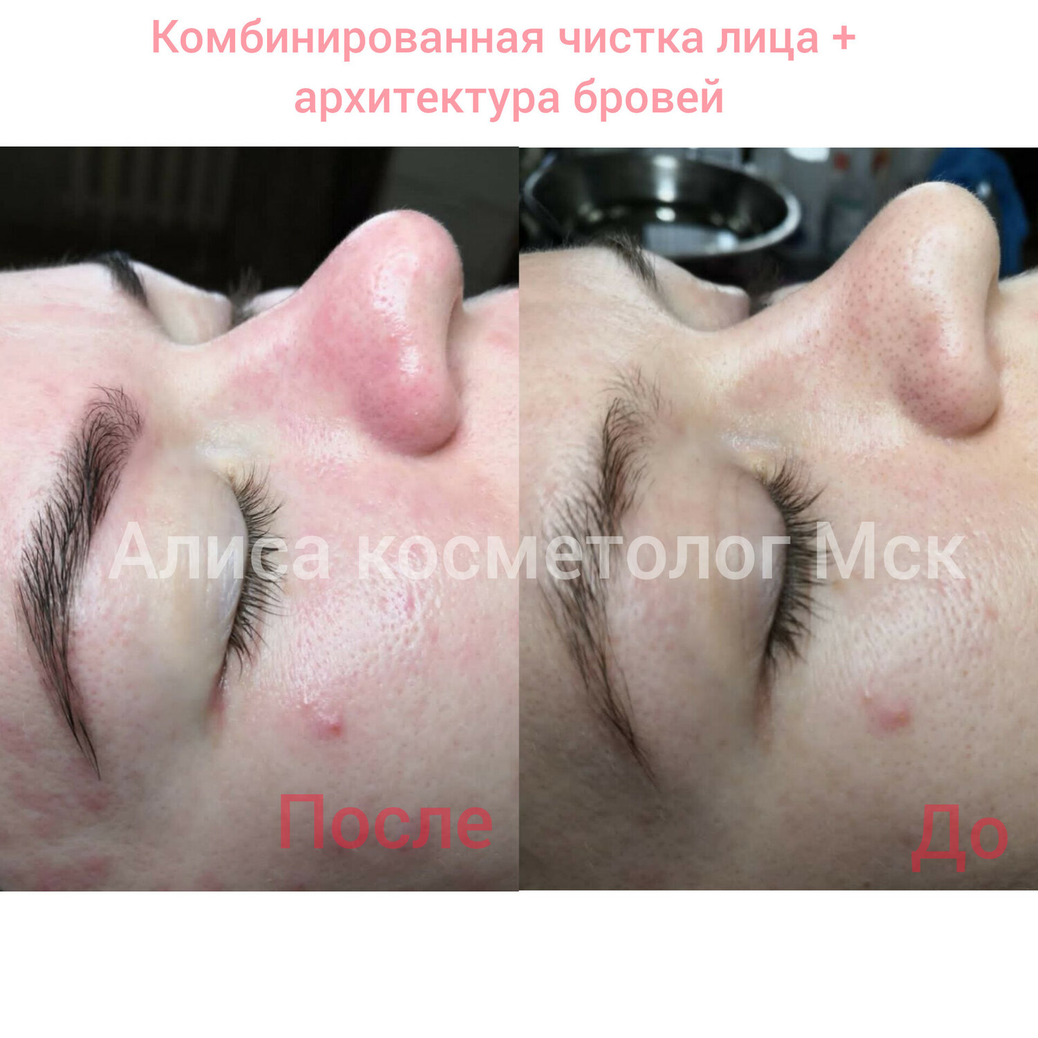 после чистки лица, до и после чистки лица, комбинированная чистка лица, пилинг, чистка лица лазером