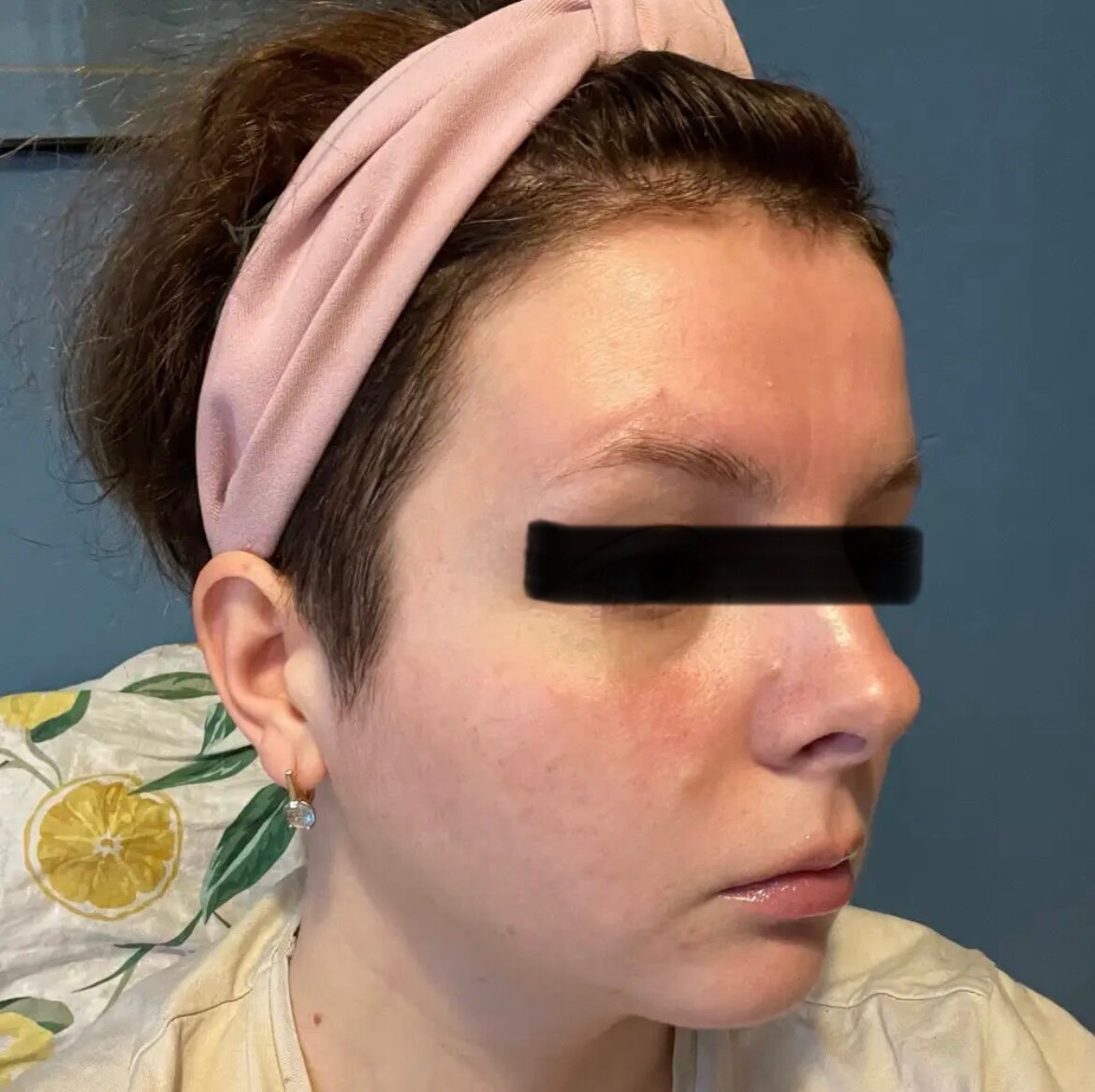 подтяжка лица, подтяжка овала лица, подтяжка лица нитями, нижняя треть лица, овал лица