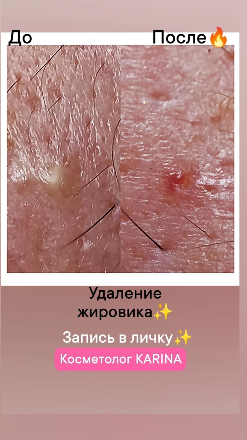 удаление прыщей, выдавливание прыщей, прыщи, давить прыщи