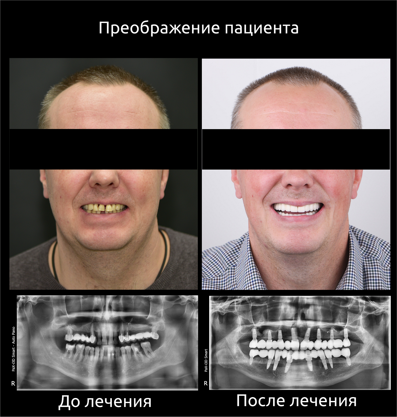 зубы, импланты с памятью формы, имплантаты, зубной имплантат, улыбки