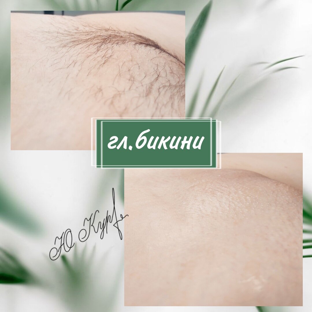 шугаринг глубокое бикини, шугаринг, эпиляция глубокого бикини, электроэпиляция глубокого бикини, депиляция