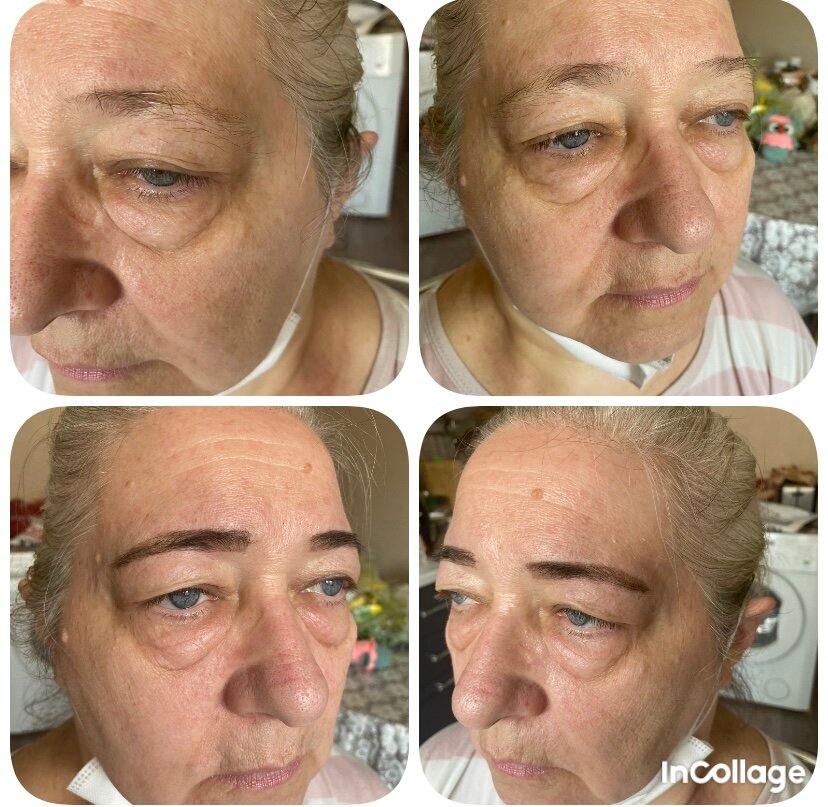 плазма лифтинг для лица, блефаропластика век, блефаропластика, безоперационная лазерная блефаропластика век, блефаропластика верхних век