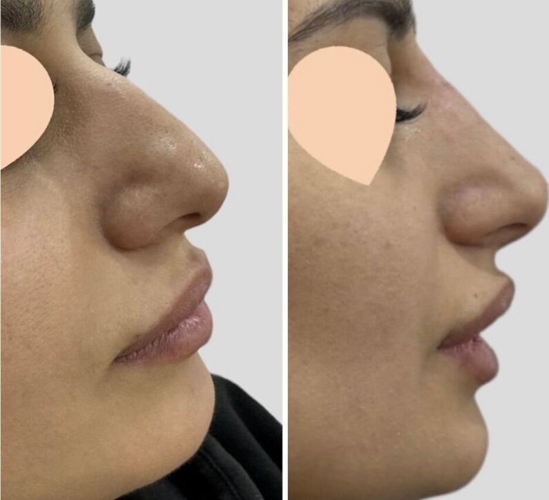 пластика носа, ринопластика гюсан, нос ринопластика, безоперационная ринопластика носа, ринопластика кончика носа