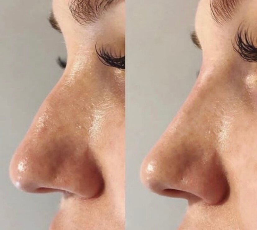 коррекция носа филлерами, пластика носа, безоперационная пластика носа, нос ринопластика, безоперационная ринопластика носа