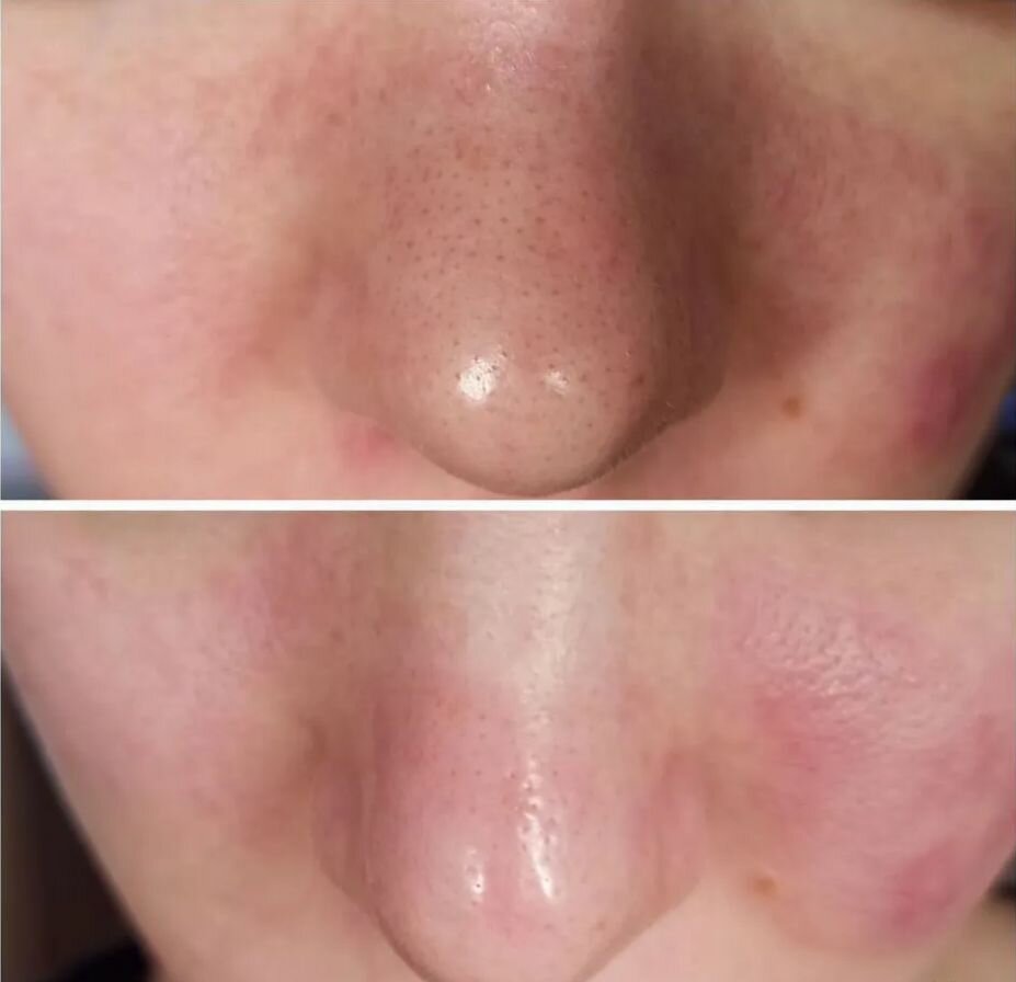 ���������������� ������ ���������������� ������������ ���������� ciracle pore control blackhead off sheet, ���������������� ������ ���������������� ������������ ���������� ciracle pore, ciracle �������������� ������ ���������������� ������������ ���������� ciracle, ���������������� ���� ������������ ���������� ciracle, ���������������� ������ ���������������� ������������ ���������� ciracle