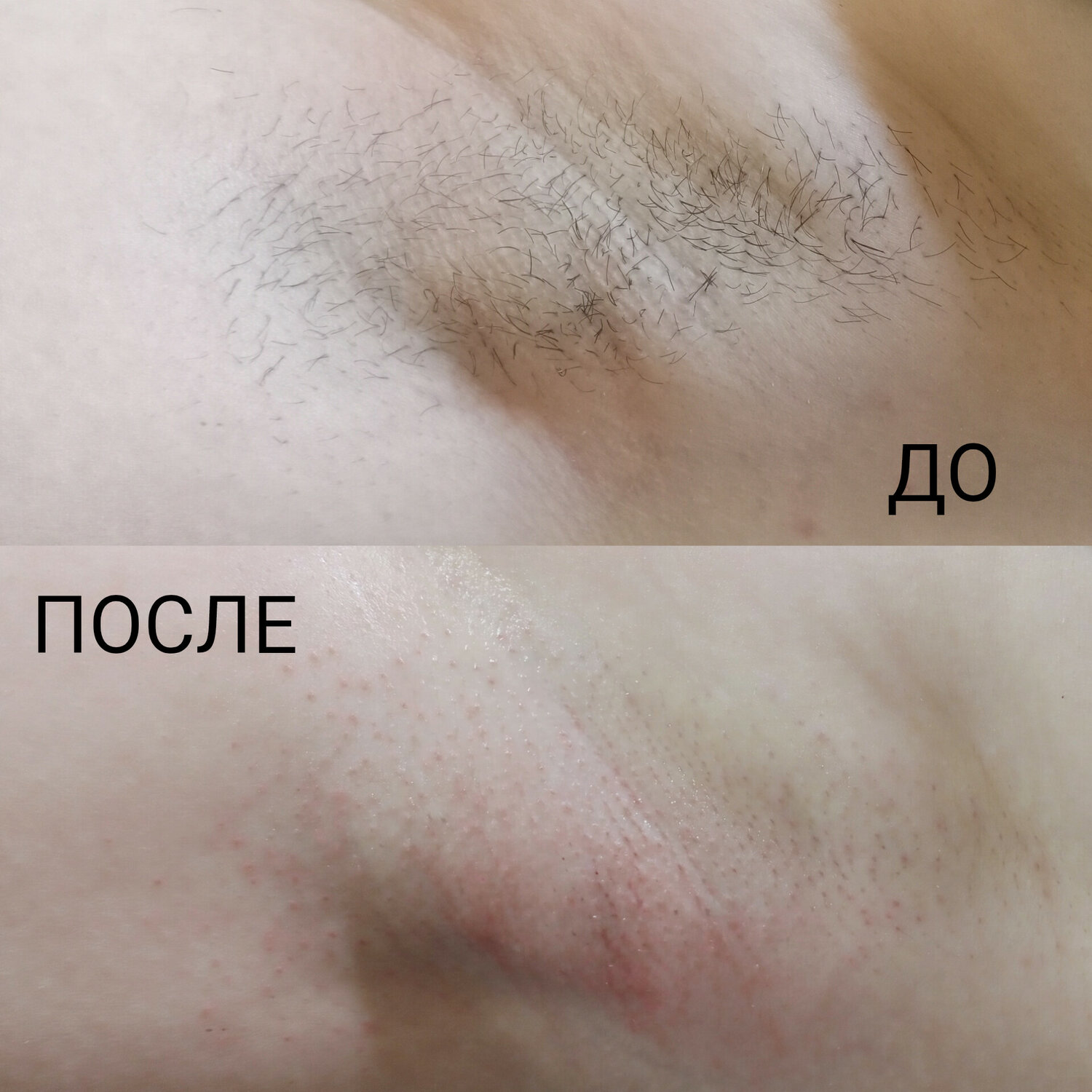 электроэпиляция, после лазерной эпиляции, восковая депиляция, восковая эпиляция, электроэпиляция подмышек