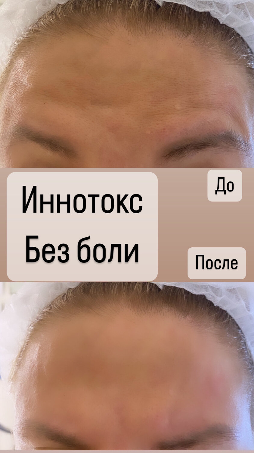 ботулинотерапия до и после, ботулакс до и после, до и после ботокса, межбровье, ботокс для лица