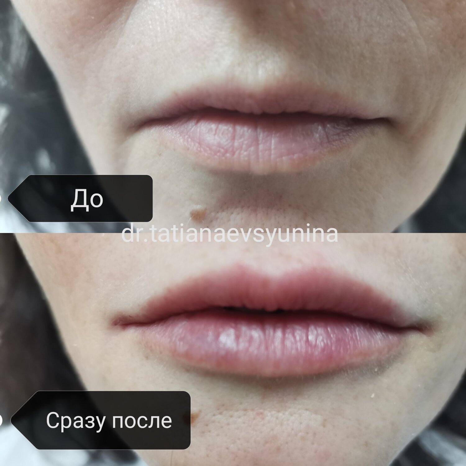 губы ювидерм смайл до и после, лица, часть лица, микроблейдинг губ напыление, филлеры