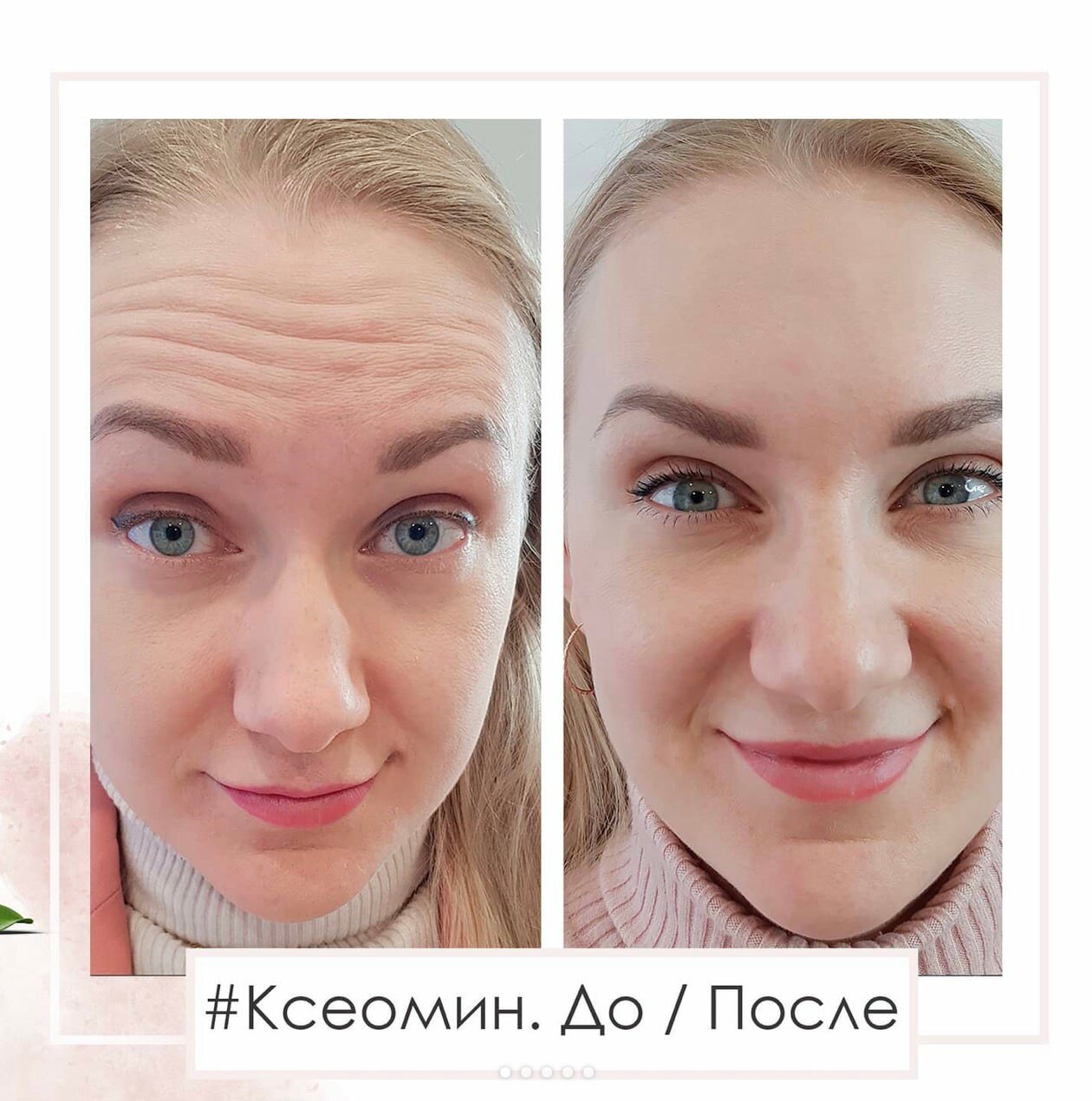 ботокс лица, ботокс между бровей, межбровье, лифтинг лица, омоложение лица
