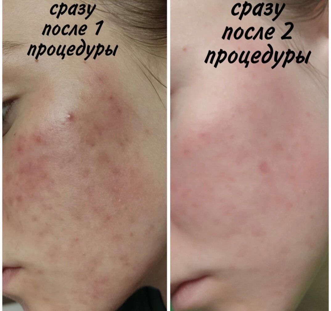 лечение акне, акне, постакне, акне и постакне, процедура